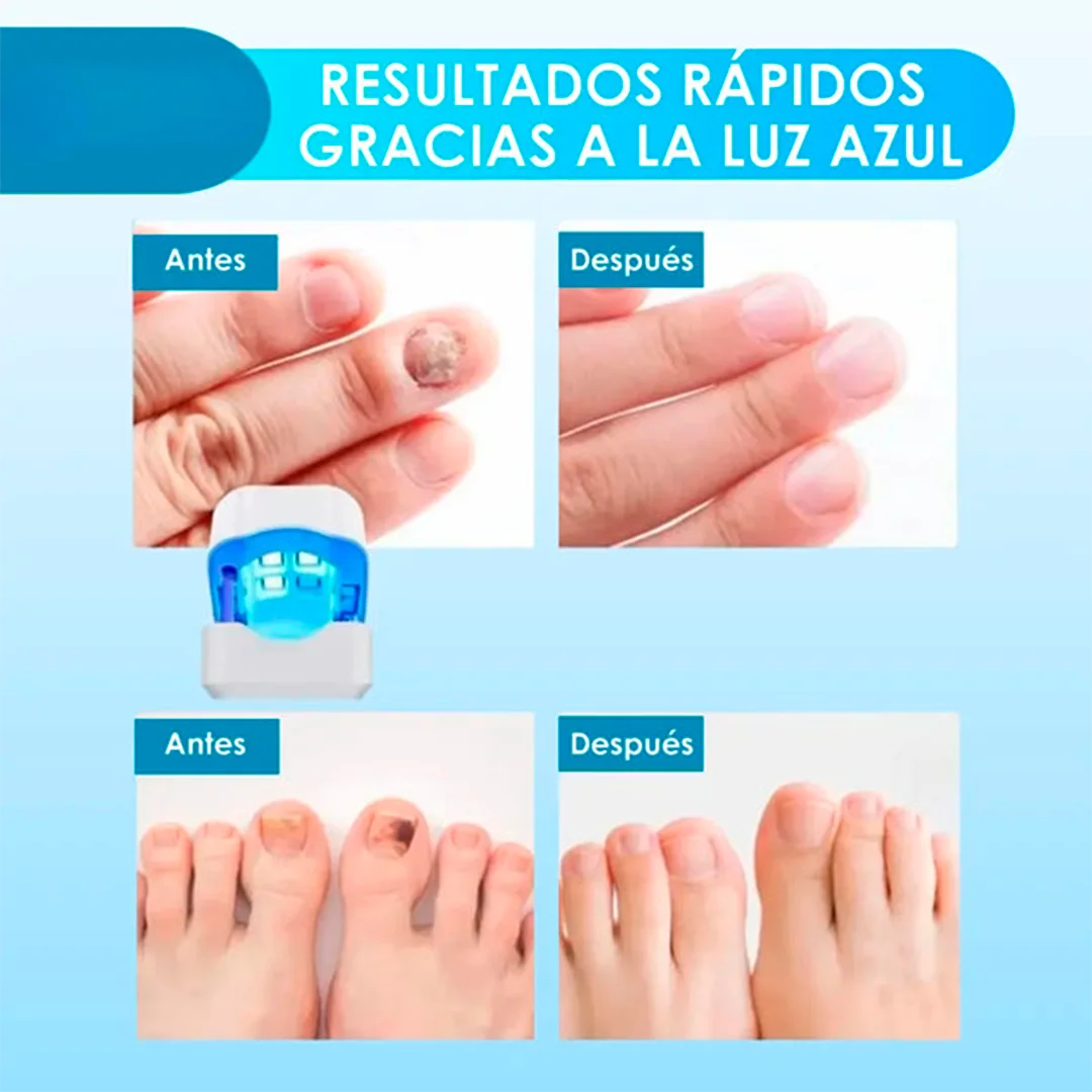 ¡Unas fuertes y libres de hongos en 7 minutos por ciclo! - CuraLáser