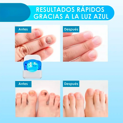 ¡Unas fuertes y libres de hongos en 7 minutos por ciclo! - CuraLáser